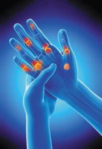 Arthritis: Ketika Sendi Bicara dalam Bahasa Nyeri