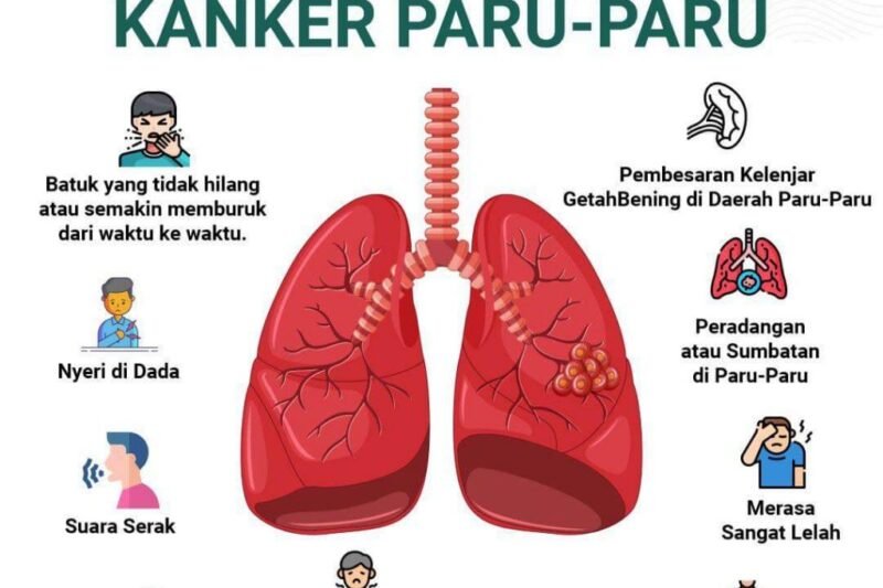 Kanker Paru-Paru: Ancaman yang Terus Berkembang dan Harapan di Tengah Kemajuan Ilmu Pengetahuan