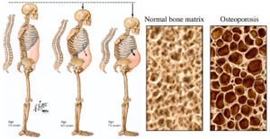 Osteoporosis: Tulang Rapuh yang Mengintai, Kenali dan Cegah Sejak Dini