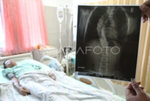 Penyakit langka 2025